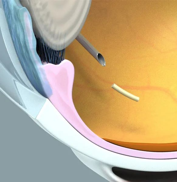 OTX-TKI(axitinib intravitreal implant)