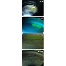 OTX-TIC(travoprost intracameral implant)