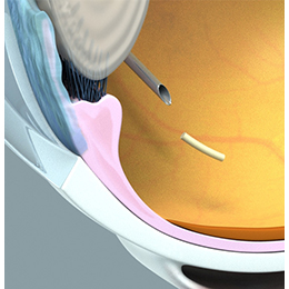 Intravitreal injection of OTX-TKI implant
