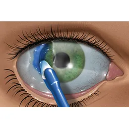 ReSure Sealant